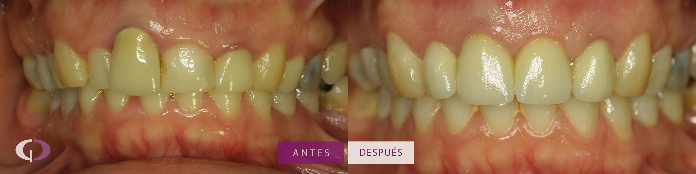 Alargamiento de corona - Clínica Odontología Especializada