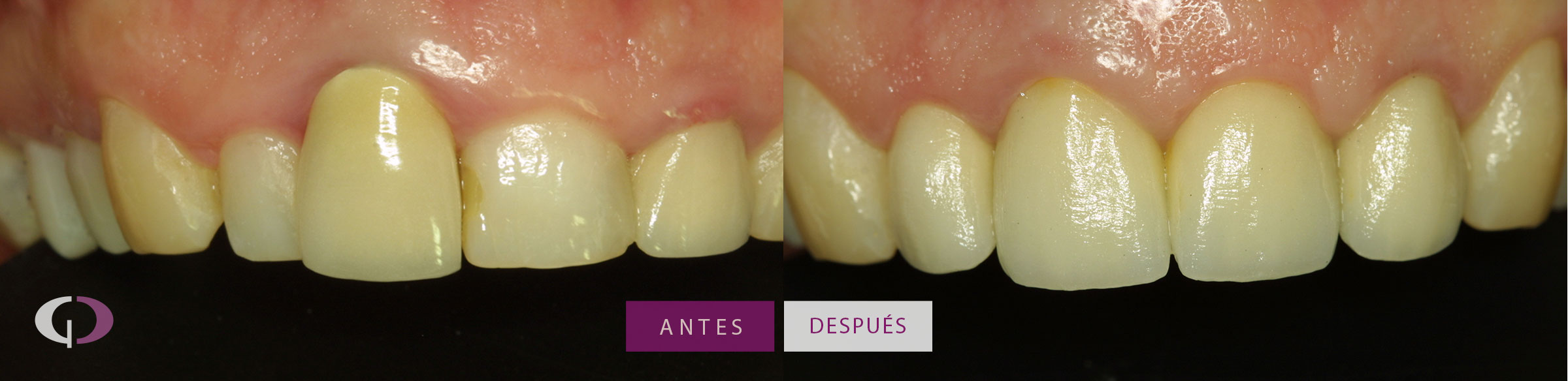 Alargamiento de corona - Clínica Odontología Especializada