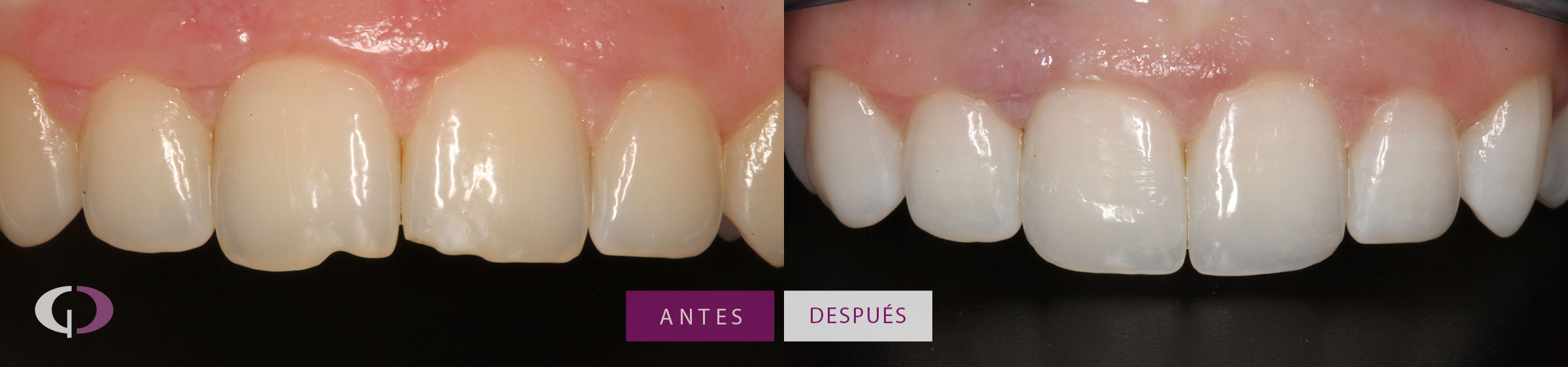 Reconstrucción dental composite