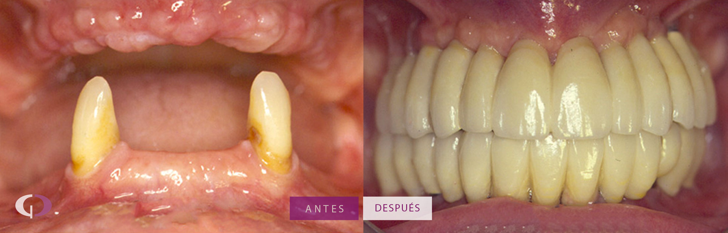Implantes Dentales antes y después