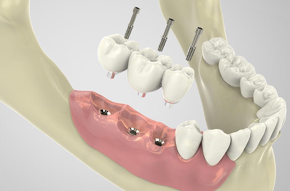 Implantes Dentales en Madrid