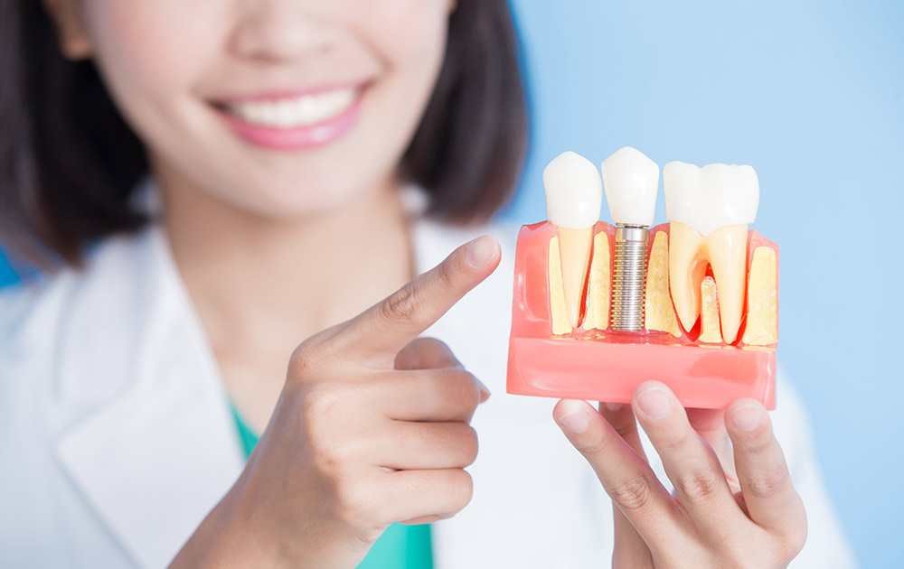 Pueden dar problemas los implantes dentales? 