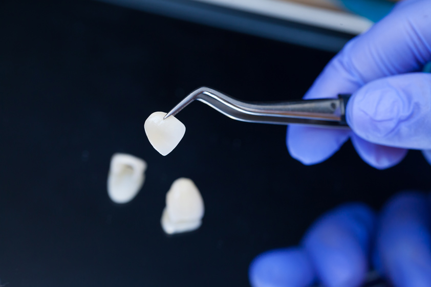 Odontólogo sujetando unas carillas dentales de porcelana con pinzas